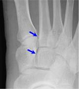 Lisfranc with arrows-2